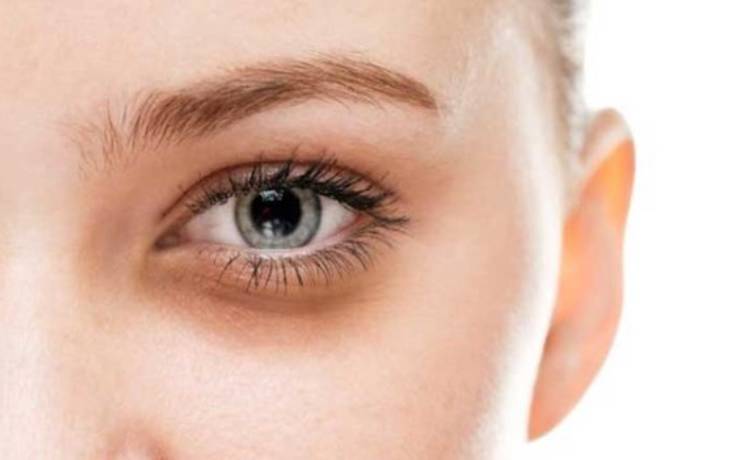 شش روش از بین بردن تیرگی زیر چشم